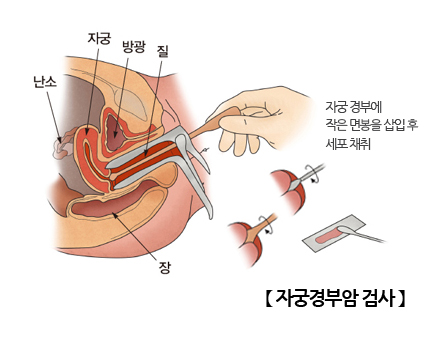 자궁경부암 검사