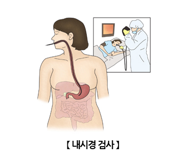 내시경